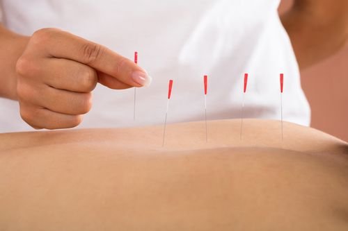 שירותי דיקור סיני בחיפה – למי זה מתאים